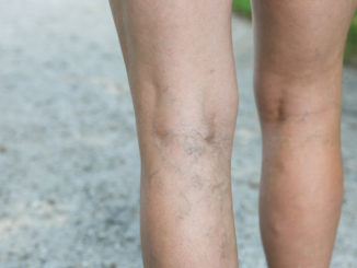 Ulcere alle gambe