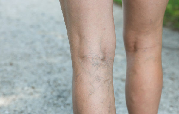 Ulcere alle gambe Ulcere alle gambe